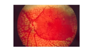 retina lézeres kezelése